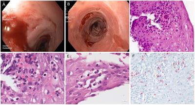 Case report: Lichenoid esophagitis revealing an HIV infection